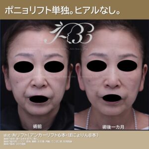 50代　ぽにょリフト