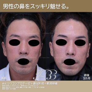 プロテーゼ、鼻尖形成、軟骨移植