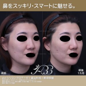20代　鼻プロテーゼ、鼻尖形成、軟骨移植