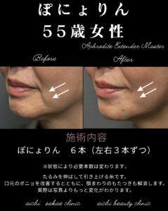 ぽにょりん６本