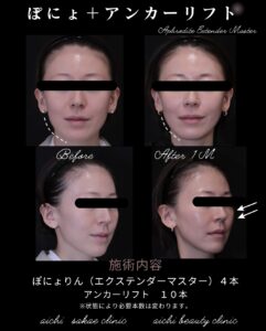 ぽにょりん４本アンカーリフト１０本