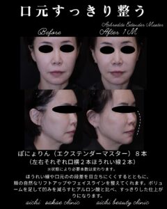 ぽにょりん８本