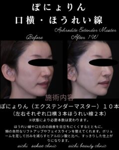 ぽにょりん１０本