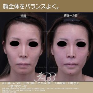 30代女性　全顔トータルバランス