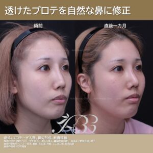 【他院修正】太い、短い、厚い。三拍子揃ったプロテを自然な鼻に