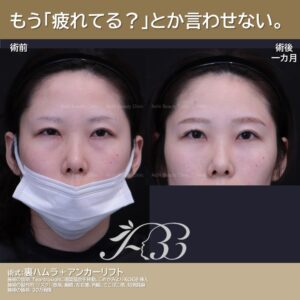 裏ハムラ＋ミッドフェイスリフト