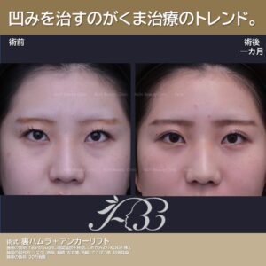 20代のくま治療