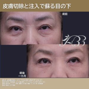 クマトリ後修正