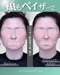 ベイザー脂肪吸引ホホアゴ