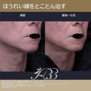 メンズ脂肪注入