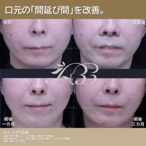 人中短縮でのっぺり顔改善