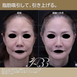 脂肪吸引＋糸リフトでリフトアップ