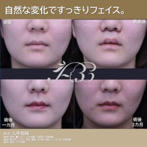 おちょぼ口への人中短縮