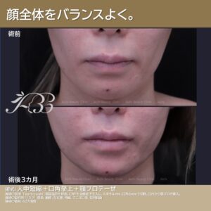 顎プロテーゼはシャクれない。