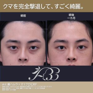 大人気！メンズくま治療